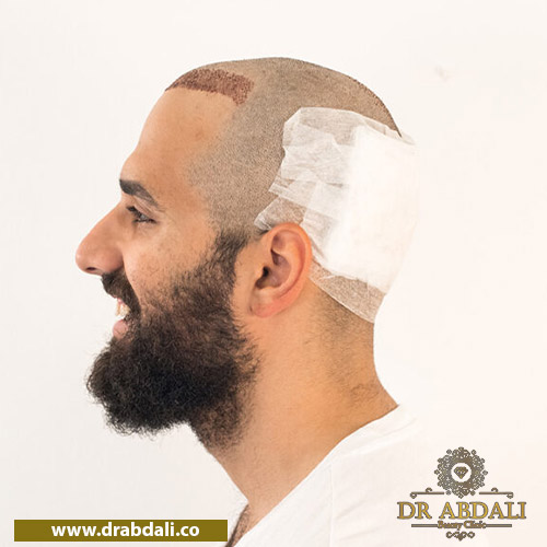 تورم پس از کاشت مو - دلایل تورم