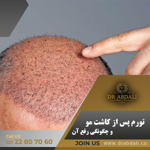 تورم پس از کاشت مو
