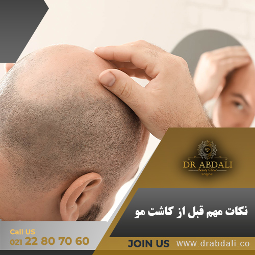 نکات مهم قبل از کاشت مو