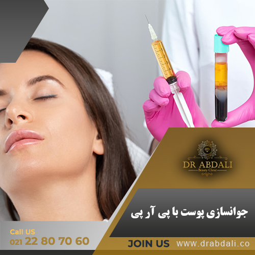 پی آر پی - دکتر ابدالی