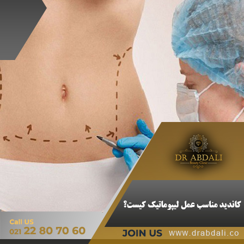 عمل لیپوماتیک- دکتر ابدالی