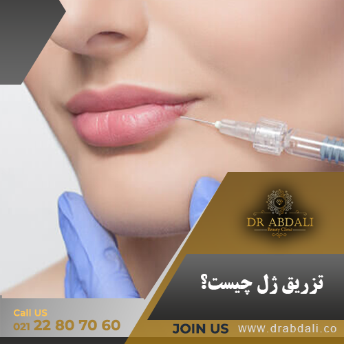 تزریق ژل- دکتر ابدالی