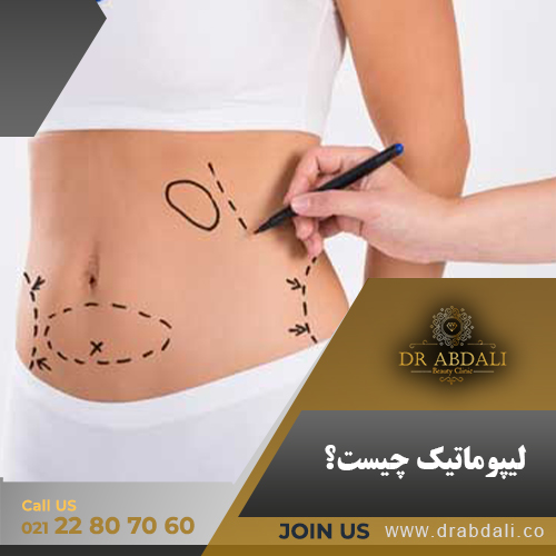 لیپوماتیک چیست - دکتر ابدالی