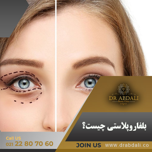 بلفاروپلاستی چیست؟- دکتر ابدالی