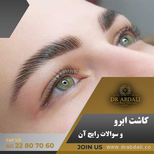 کاشت ابرو- دکتر ابدالی