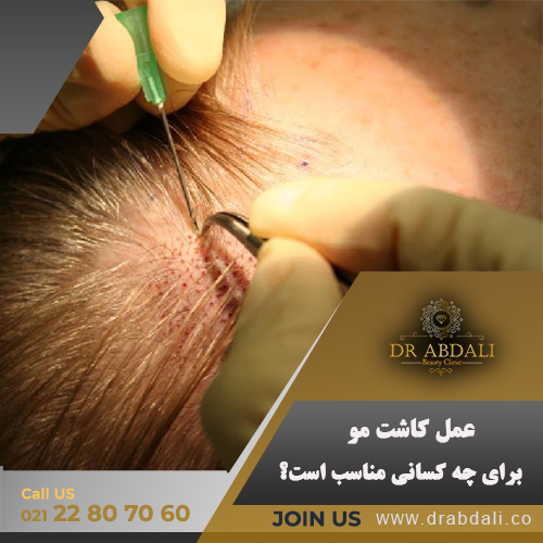 عمل کاشت مو - دکتر ابدالی