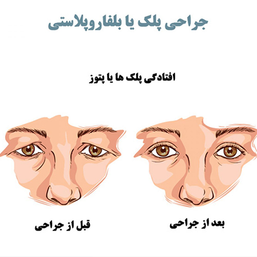 مزایای بلفاروپلاستی - پتوز