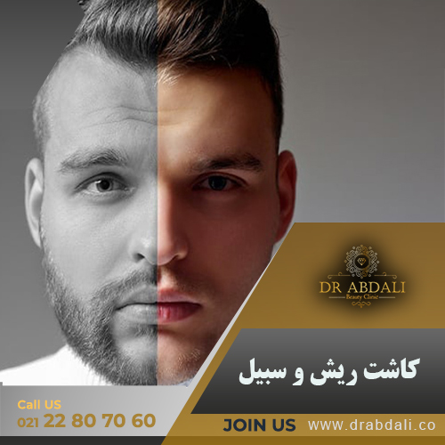 کاشت ریش و سبیل - دکتر ابدالی