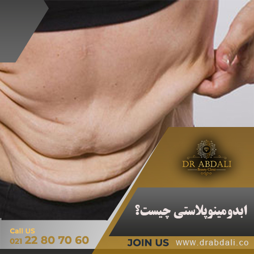 ابدومینوپلاستی - دکتر ابدالی