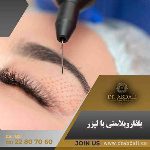 بلفاروپلاستی با لیزر - دکتر ابدالی