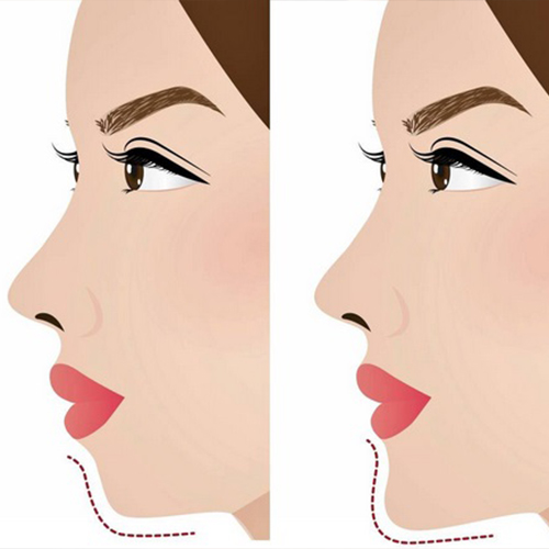 تزریق ژل چانه - نتیجه عمل