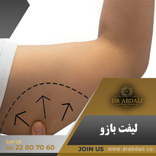 لیفت بازو - کلینیک دکتر ابدالی