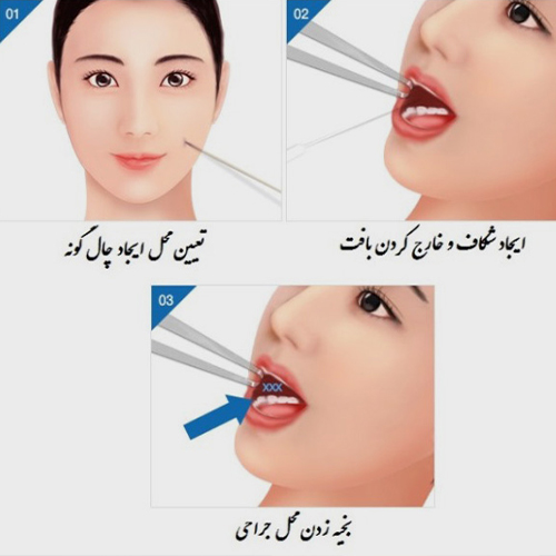 چال گونه - انجام عمل جراحی
