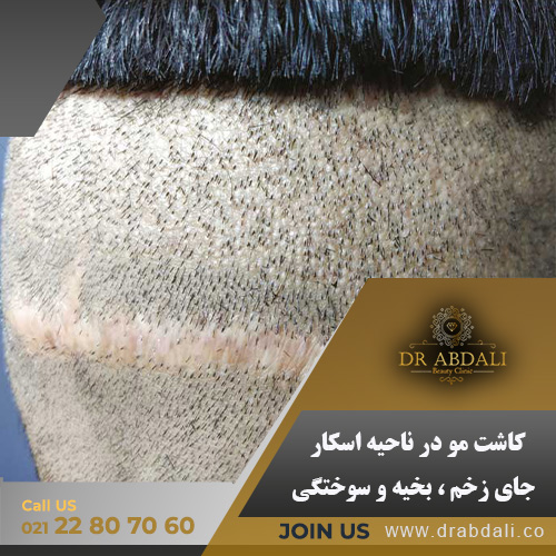 کاشت مو در ناحیه اسکار - کلینیک دکتر ابدالی