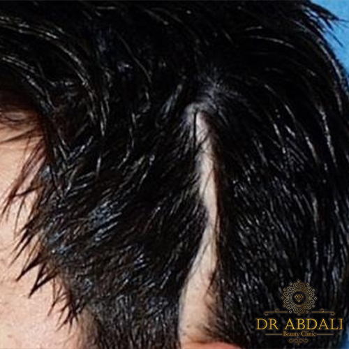 کاشت مو در ناحیه اسکار - موارد اثرگذار