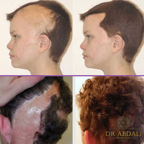 کاشت مو در ناحیه اسکار - انواع اسکار