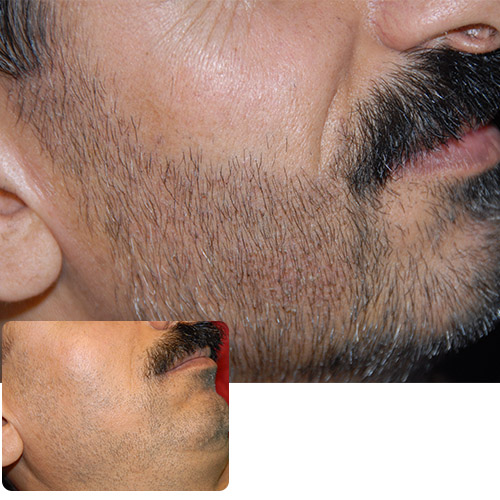 کاشت ریش و سبیل- دکتر ابدالی