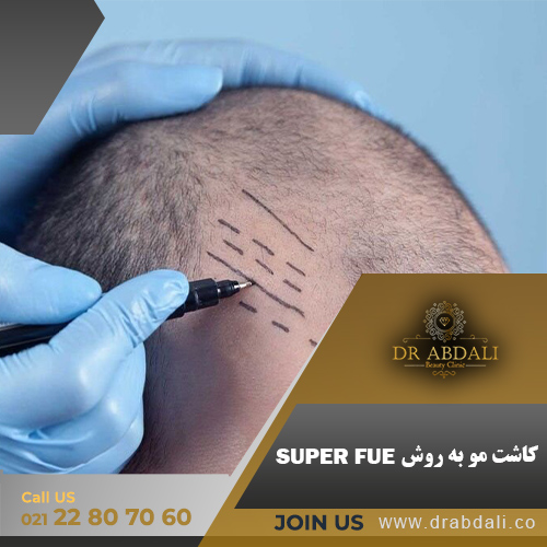 کاشت مو به روش SUPER FUE - دکتر ابدالی