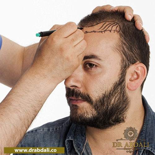 کاشت مو به روش SUPER FUE - توصیه های قبل از عمل