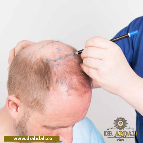 کاشت مو به روش SUPER FUE- مراقبت بعد از عمل