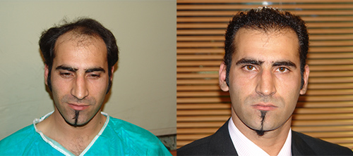 کاشت مو طبیعی - کاشت مو