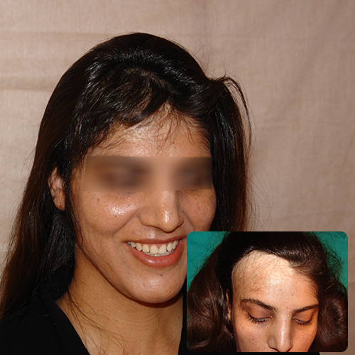 کاشت مو - کاشت مو زنانه