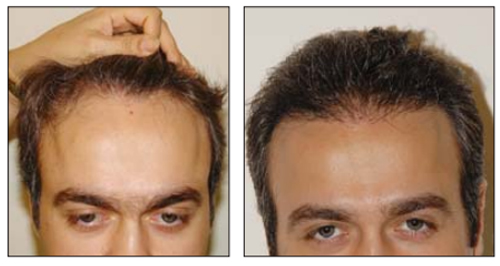 کاشت مو - کاشت مو طبیعی - دکتر ابدالی