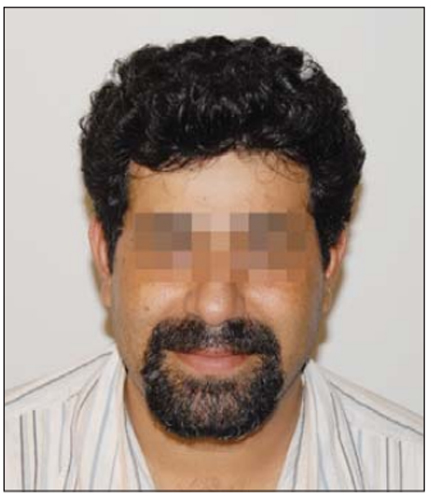 کاشت مو - کاشت مو طبیعی - دکتر ابدالی