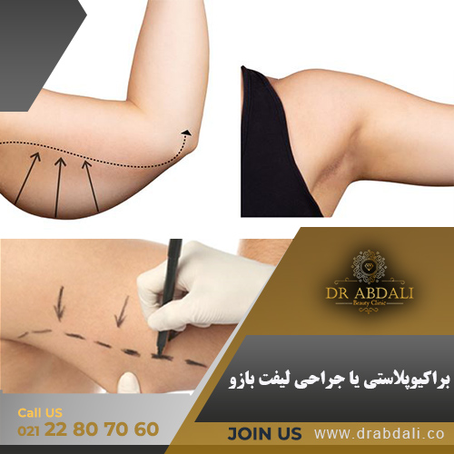 براکیوپلاستی - کلینیک دکتر ابدالی