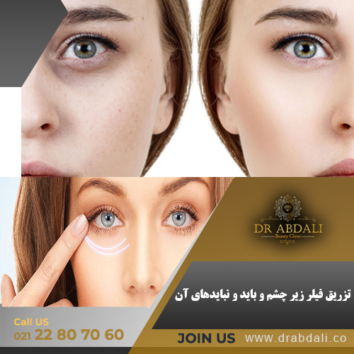 تزریق فیلر زیر چشم - کلینیک دکتر ابدالی