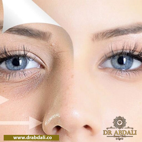 تزریق فیلر زیر چشم - فیلر زیر چشم چیست