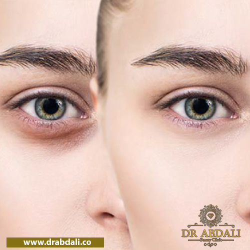 تزریق فیلر زیر چشم - عوارض جانبی