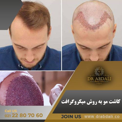 کاشت مو به روش میکروگرافت - دکتر ابدالی