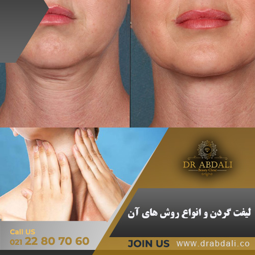لیفت گردن - کلینیک دکتر ابدالی